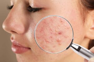 acne care trattamento anti acne